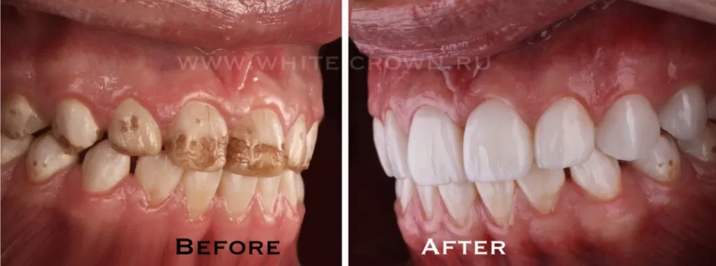 Цельнокерамические коронки имакс на зубы верхней челюсти при флюорозе